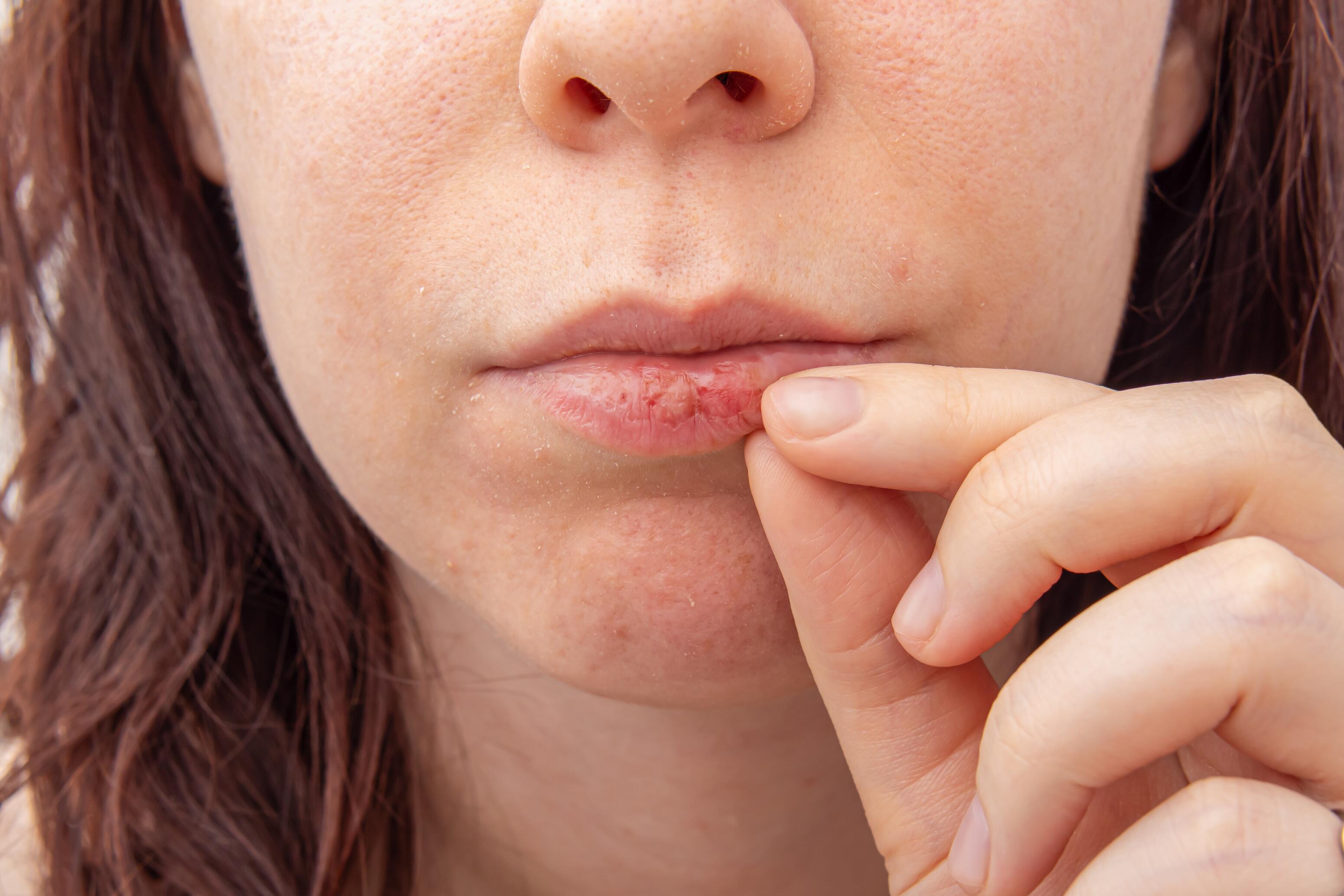 dermite périorale irritation bouche